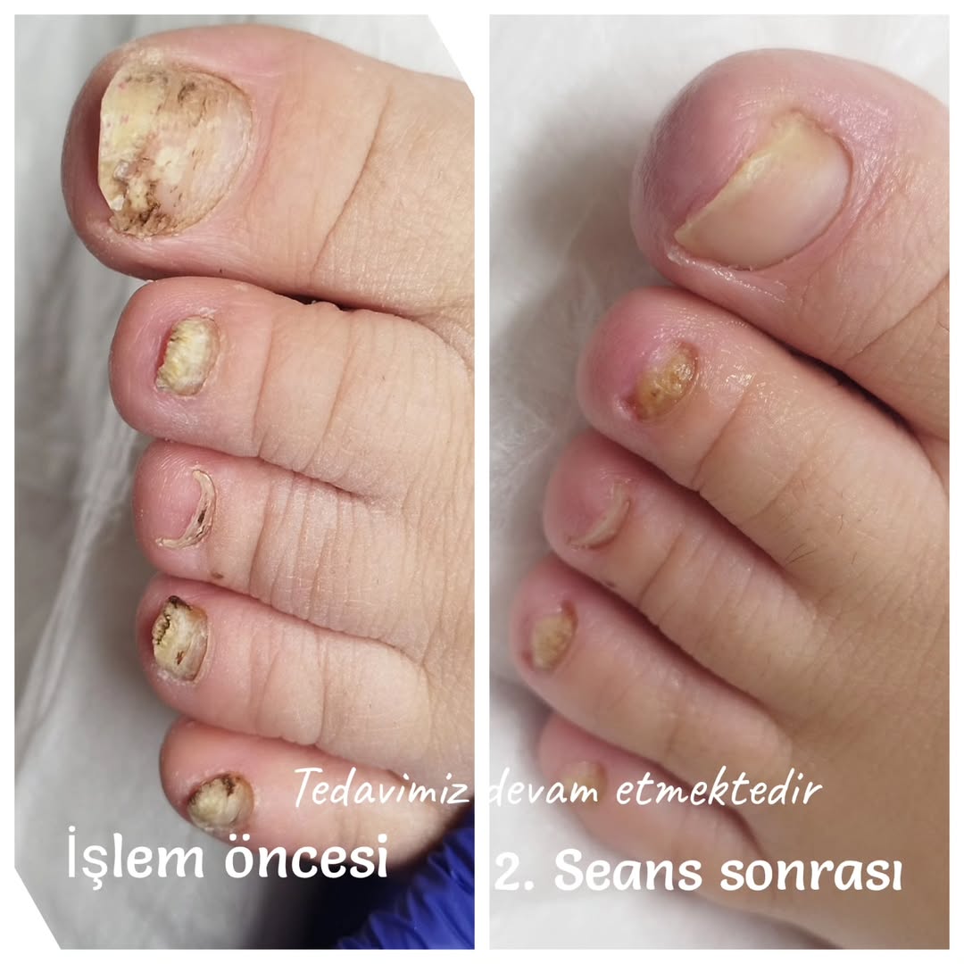 Mantar Tedavisi